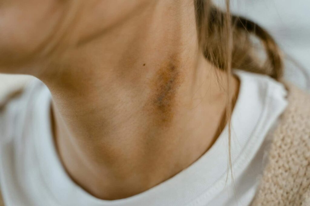 detailed close up image of a neck showing a visible bruise or scar emphasizing skin texture. 7699292 scaled 1