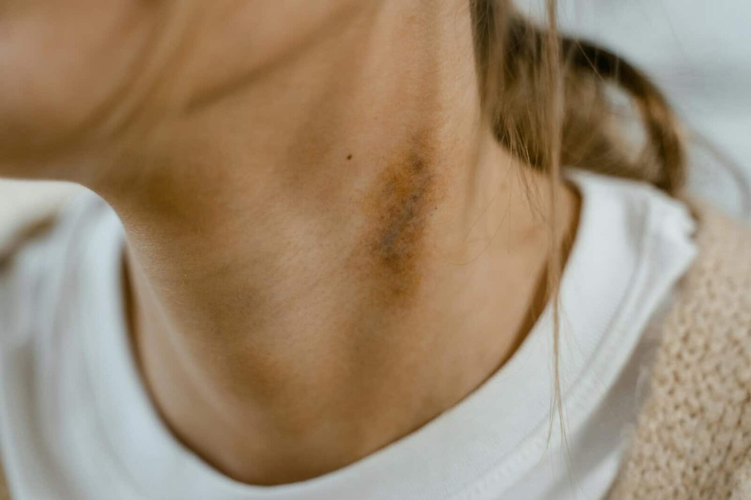 detailed close up image of a neck showing a visible bruise or scar emphasizing skin texture. 7699292 scaled 1