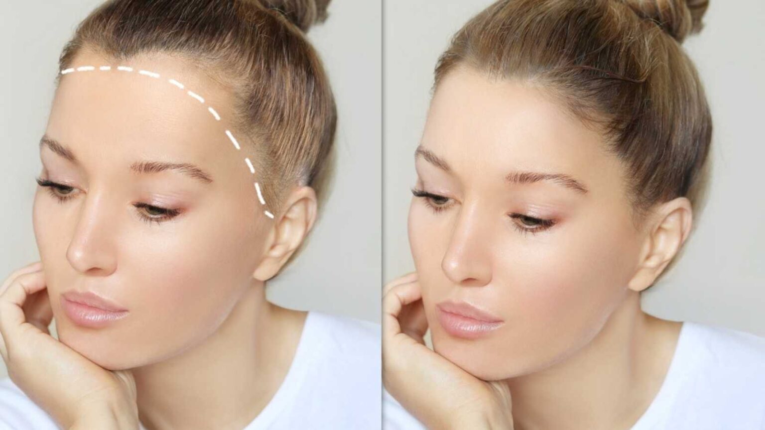 traction alopecia tight braids